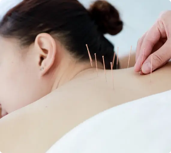 acupuncture service