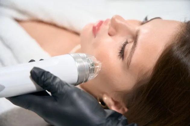 microneedling treatment in arlington, va