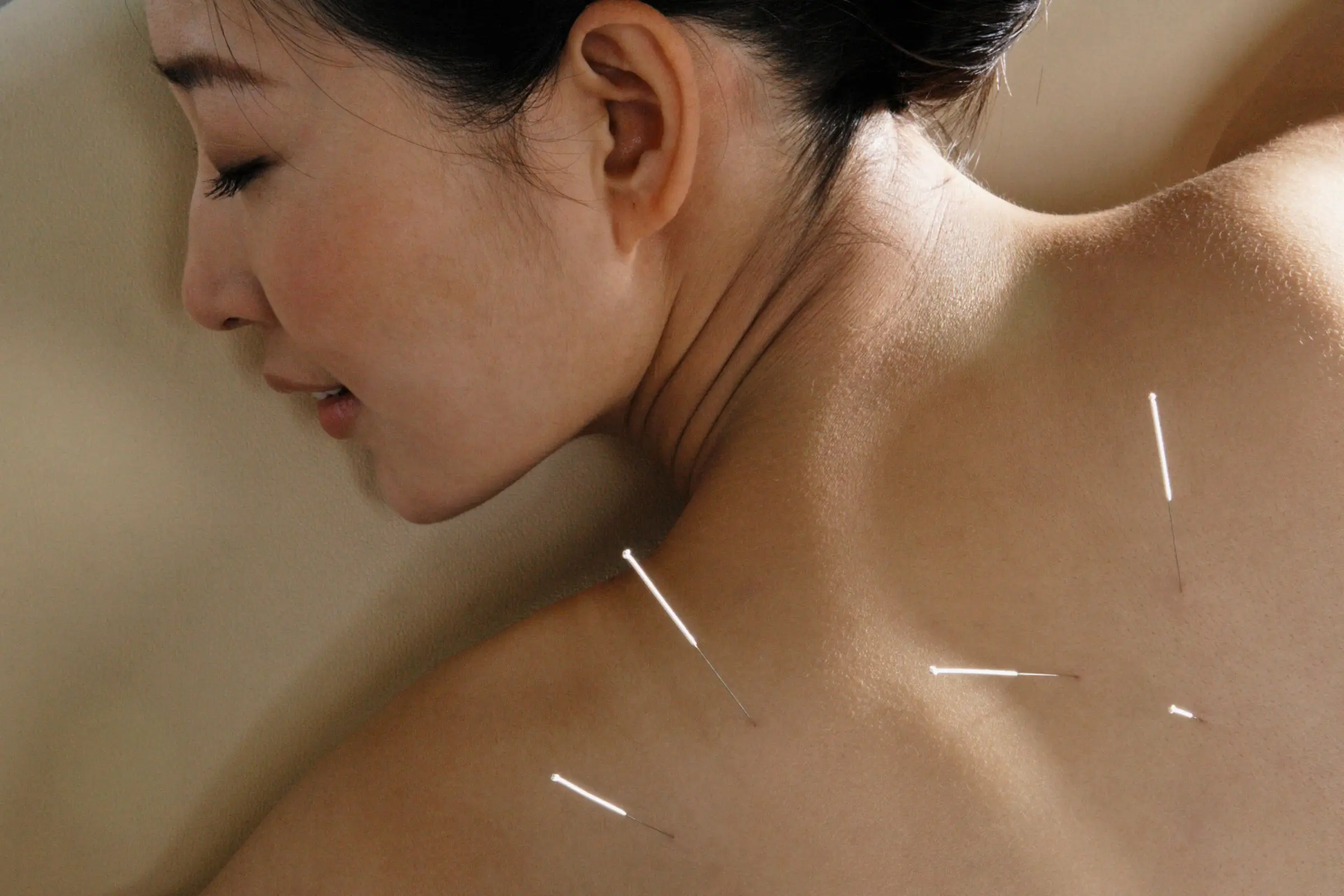 acupuncture Spa in Tysons Corner VA