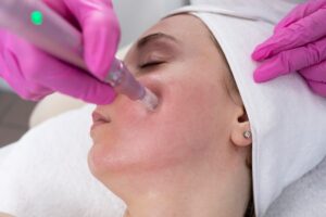 Woman receiving microneedling facial treatment